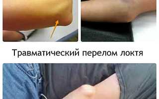 Лечение перелома локтевого сустава
