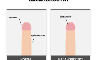 Как лечить кандидозный бланопостит у мужчин?