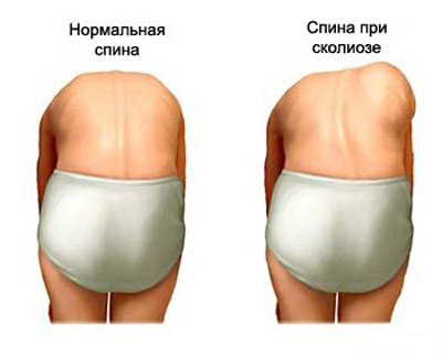 сколиоз нельзя не заметить